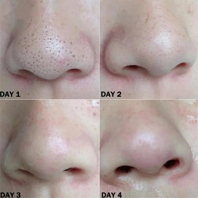 Nose Blackhead Remover Mask Nasal Strips Black Head